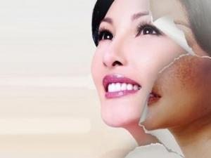 激光可以祛斑嗎？激光可以去除哪些斑