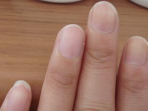 手指甲上有豎紋怎么辦?指甲上有黑色豎紋是怎么回事