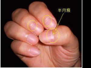 指甲上的半月痕你懂多少？指甲半月痕與健康吉兇