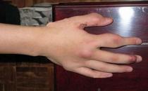 秋冬警惕風濕性關節病 如何預防？