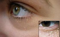 粒粒皆辛苦？找準原因輕松治脂肪粒！