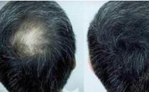 頭發(fā)種植的方式有哪些？