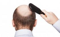 7類脫發誘因男人治療要分清