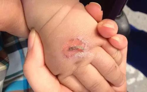 孩子常見的意外損傷類型有哪些？