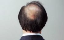 想要遠離脫發 男人要做持久戰