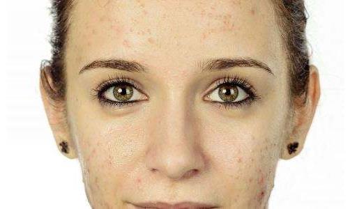 皮膚出油是缺水嗎?皮膚出油怎么辦