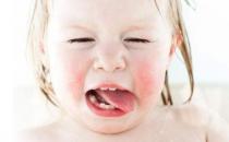 什么是蟯蟲病？蟯蟲的癥狀有哪些