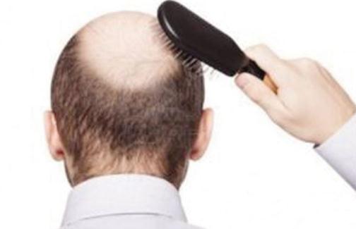 想要遠離脫發 男人應做持久戰