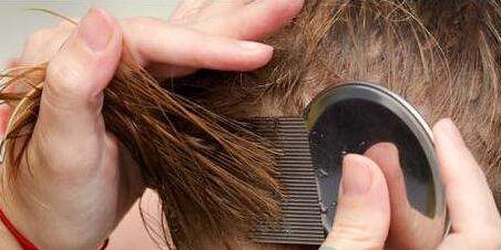 頭上長虱子怎么辦?虱子怎么去除?去虱子和虱子卵的有效方法