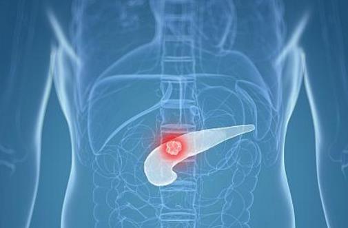 死亡率高達70％的胰腺炎，醫生提醒：有這3種現象的人尤為