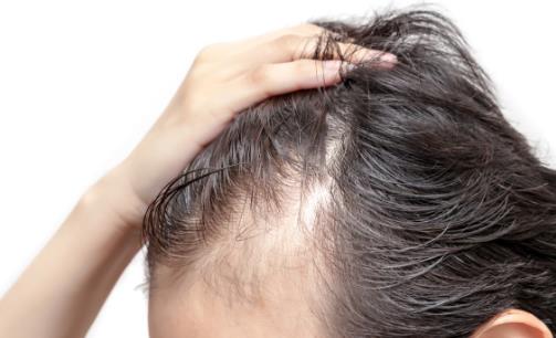 年輕人脫發嚴重 如何讓頭發濃密