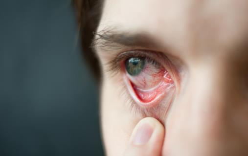 眼角發癢非小事 多半是炎癥在作怪