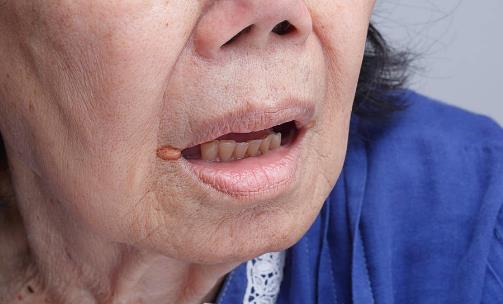 精神壓力大易導致口腔潰瘍 中醫偏方可治療口腔潰瘍