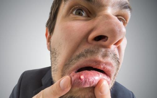 精神壓力大易導致口腔潰瘍 中醫偏方可治療口腔潰瘍