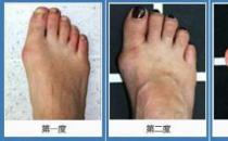 北京京醫中醫醫院治療拇外翻效果好嗎？治療安全有效有保障