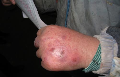 冬季長凍瘡太難受 自制凍瘡膏讓你的雙手恢復如初