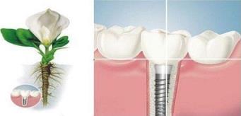 武漢做種植牙要多少錢，如何才能避免種植牙誤區呢？