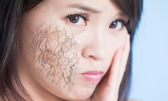 皮膚缺水的表現你中招了嗎