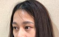 君雅筆記：眼袋過重，就會顯得比真實年齡大，要如何修復眼袋呢？