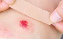 ?創可貼的另類日常妙用 六種情況下嚴禁使用創可貼