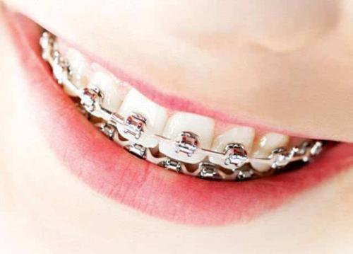 武漢德韓口腔揭秘關(guān)于牙齒矯正方案那些事兒